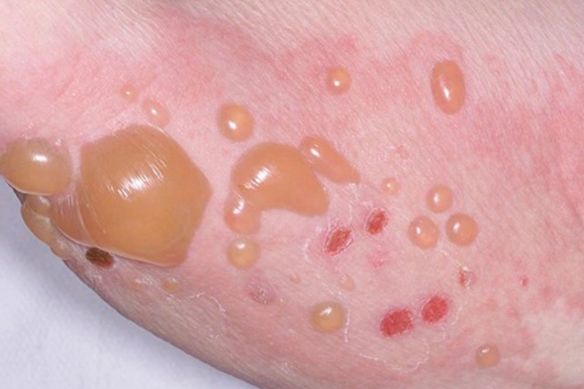 Bullous Pemphigoid: Penyakit Lepuhan yang Diam-diam Mengancam Nyawa Lansia